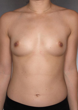 Breast Augmentation Before & After Patient #8196