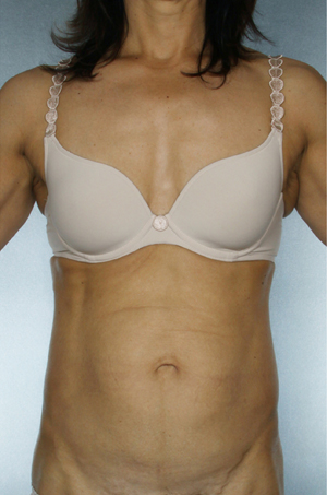 Tummy Tuck Before & After Patient #7919