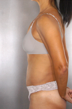 Tummy Tuck Before & After Patient #7919