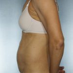 Tummy Tuck Before & After Patient #7919