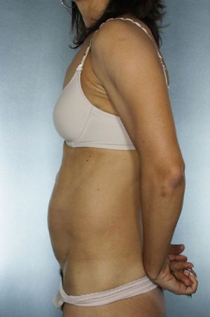 Tummy Tuck Before & After Patient #7919