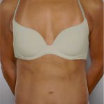 Tummy Tuck Before & After Patient #7919