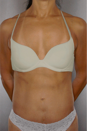 Tummy Tuck Before & After Patient #7919