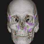 Facial Bone Fractures Before & After Patient #9393