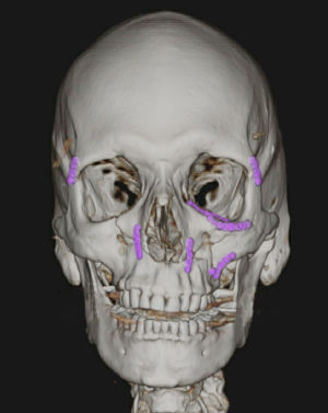 Facial Bone Fractures Before & After Patient #9393