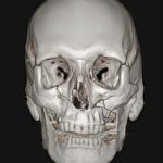 Facial Bone Fractures Before & After Patient #9393