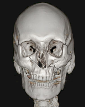 Facial Bone Fractures Before & After Patient #9393