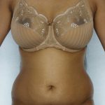 Liposuction Before & After Patient #8649