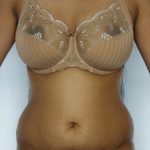 Liposuction Before & After Patient #8649