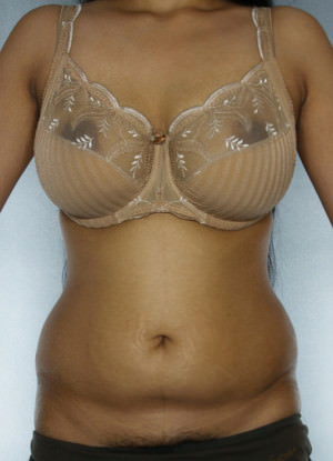 Liposuction Before & After Patient #8649