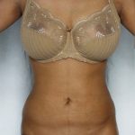 Liposuction Before & After Patient #8649