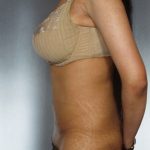 Liposuction Before & After Patient #8649