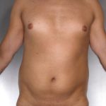 Liposuction Before & After Patient #8762