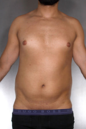 Liposuction Before & After Patient #8762