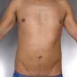 Liposuction Before & After Patient #8762