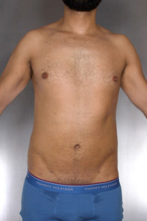 Liposuction Before & After Patient #8762