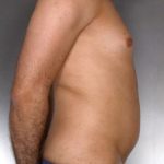 Liposuction Before & After Patient #8762