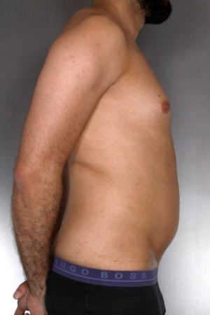 Liposuction Before & After Patient #8762