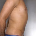 Liposuction Before & After Patient #8762