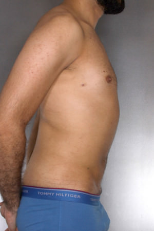 Liposuction Before & After Patient #8762