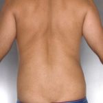 Liposuction Before & After Patient #8762