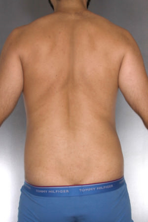 Liposuction Before & After Patient #8762