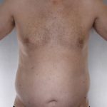 Liposuction Before & After Patient #8769