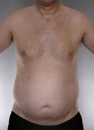 Liposuction Before & After Patient #8769