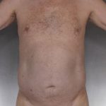 Liposuction Before & After Patient #8769