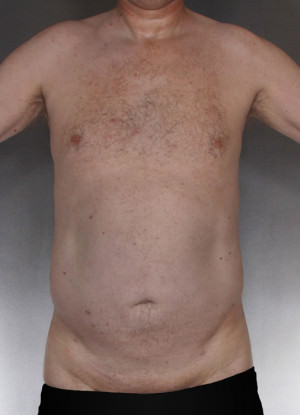 Liposuction Before & After Patient #8769