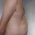 Liposuction Before & After Patient #8769