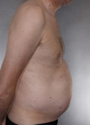 Liposuction Before & After Patient #8769