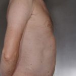 Liposuction Before & After Patient #8769