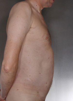 Liposuction Before & After Patient #8769