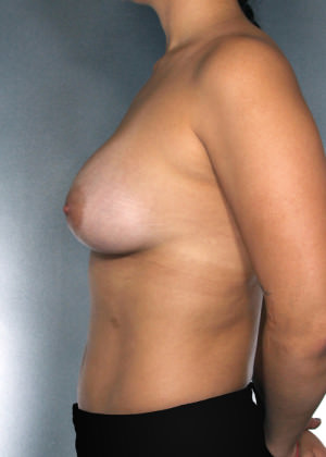 Breast Augmentation Before & After Patient #8186