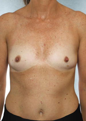 Breast Augmentation Before & After Patient #8191