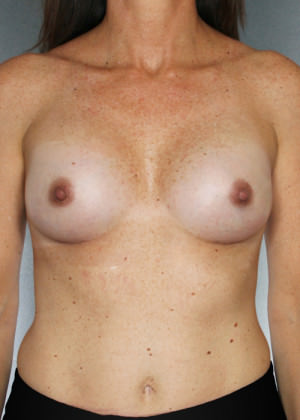 Breast Augmentation Before & After Patient #8191