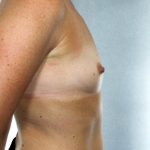 Breast Augmentation Before & After Patient #8191