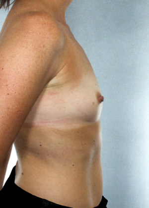 Breast Augmentation Before & After Patient #8191