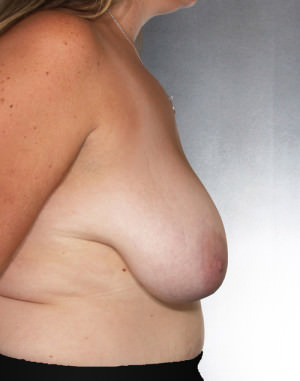 Breast Lift Before & After Patient #8219
