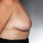 Breast Lift Before & After Patient #8219