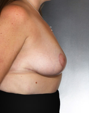 Breast Lift Before & After Patient #8219