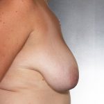 Breast Reduction Before & After Patient #8401