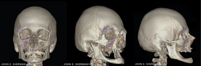 facial bone fractures new york