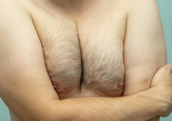 gynecomastia new york