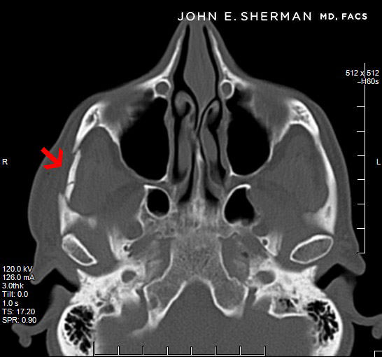 Arch Fracture treatment new york