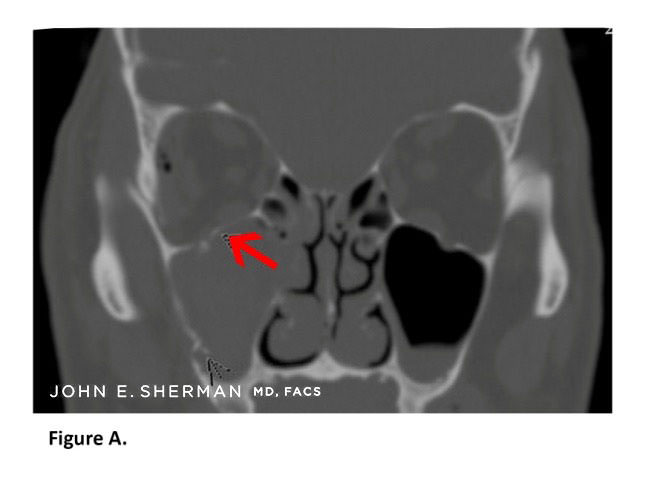 facial bone fractures new york