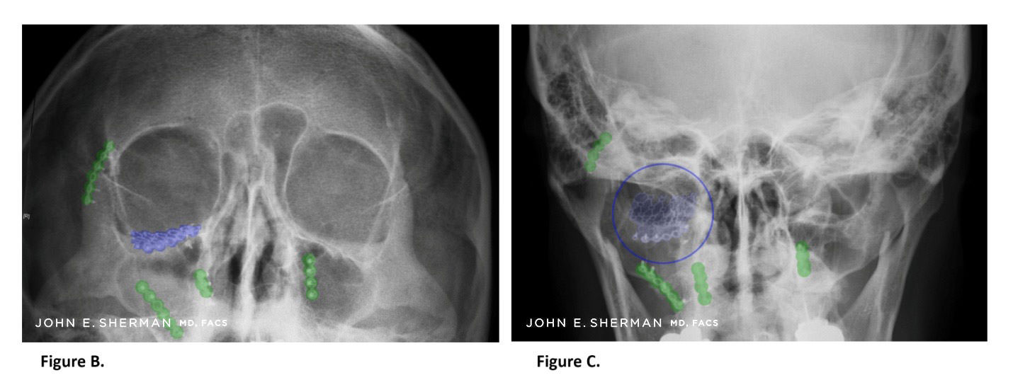 facial bone fractures new york