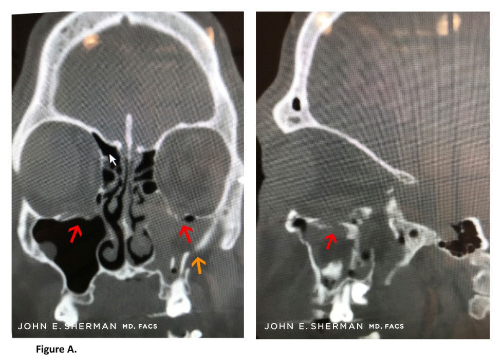 facial bone fractures new york