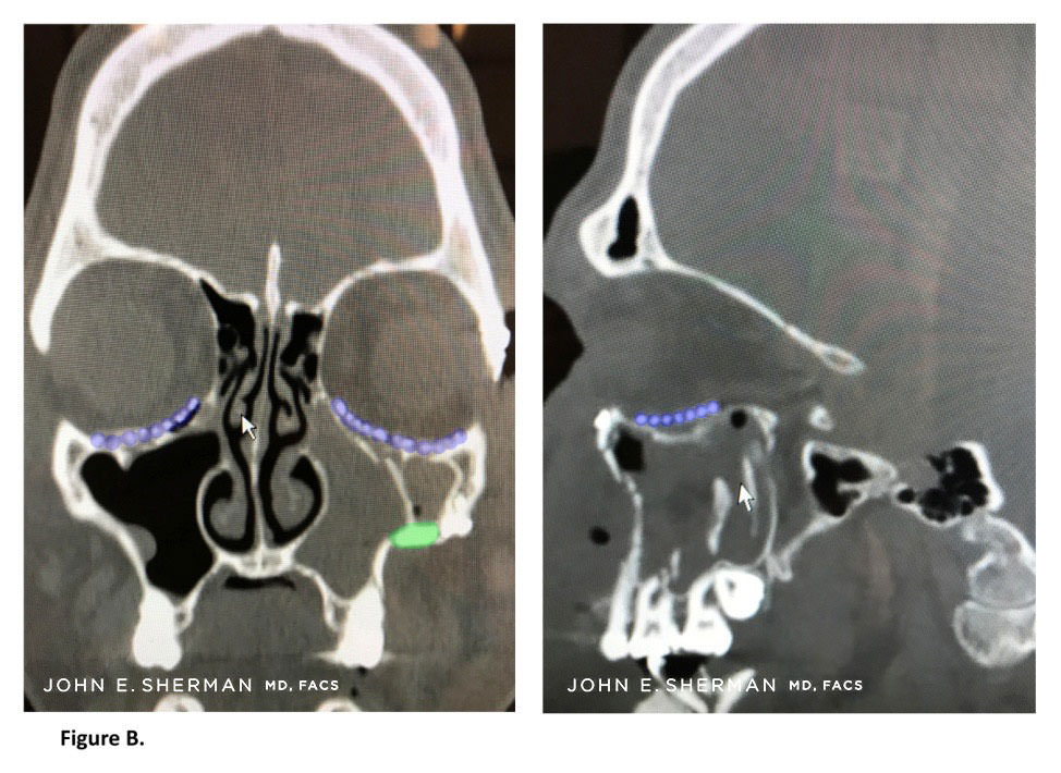 facial bone fractures new york